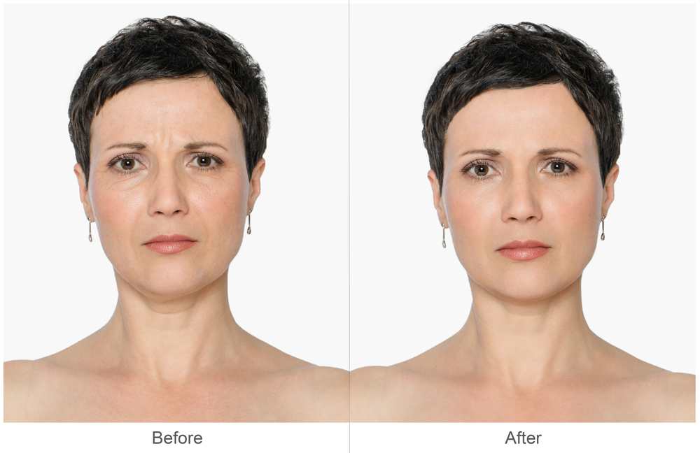 Beauty tips for reducing nasolabial folds and marionette lines TheFuss.co.uk