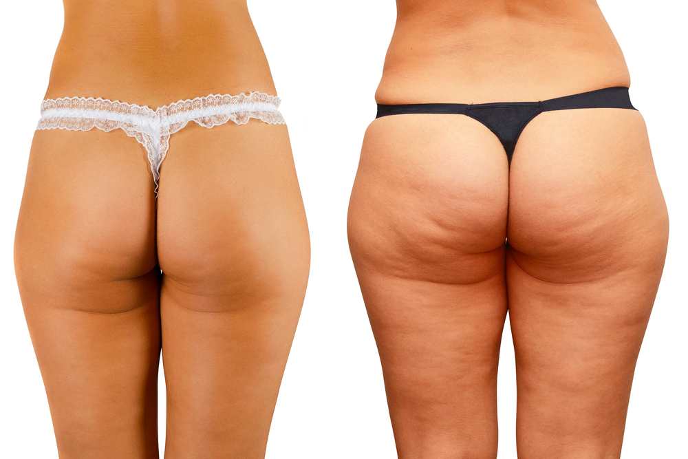 how to get rid of cellulite