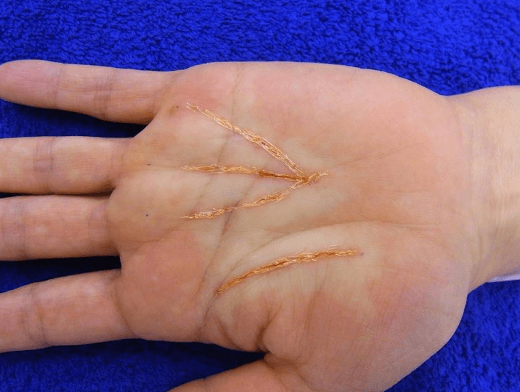 palm-altering