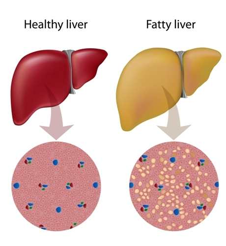 Best diet for fatty liver disease TheFuss.co.uk