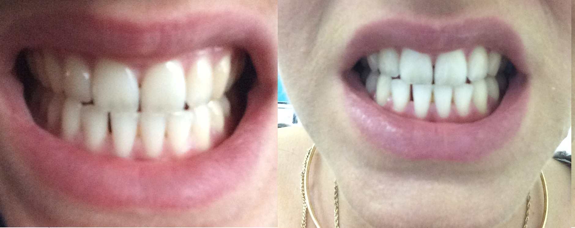Instant Whites 7 Day teeth difference TheFuss.co.uk