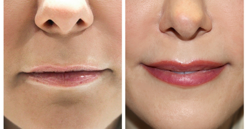 The Lip Blush treatment at Laura Kay London TheFuss.co.uk