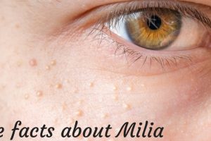 The facts about Milia TheFuss.co.uk